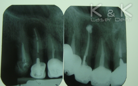 Сравнение на рентгенографиите преди и 9 месеца след лечението. Зъбът продължава да се проследява.