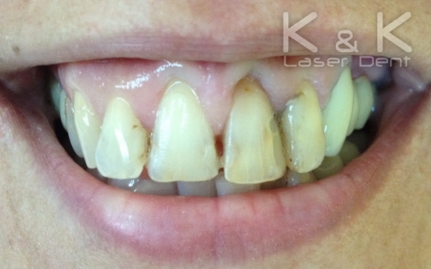 Неправилно разположени зъби  - Различни по форма и големина  - Неадекватни и оцветени обтурации (пломби) - Разстояние между зъбите