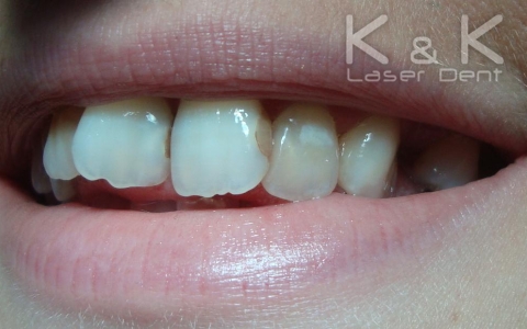 Случай 2. Вторичен кариес и стара оцветена обтурация(пломба) на зъб 21