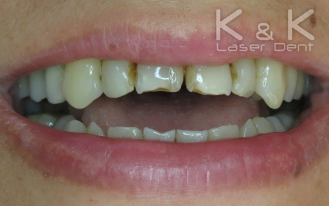 Случай 3. Състояние на пациента преди лечението. Множество стари, оцветени обтурации (пломби) на фронталните зъби. Недобре изразена линия на усмивката
 