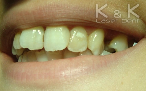 Случай 2. Композитна обтурация (пломба) на зъб 21.