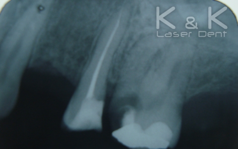 2. Диагноза : Pulpitis chronica ulcerosa на зъб 26, рентгенография преди лечение.