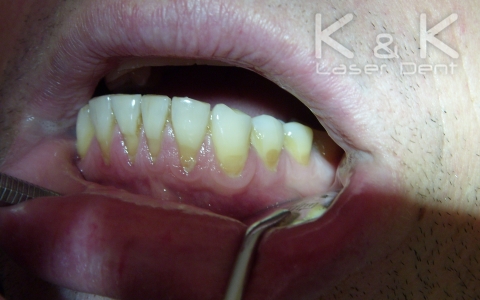 Лечение на твърди зъбни тъкани