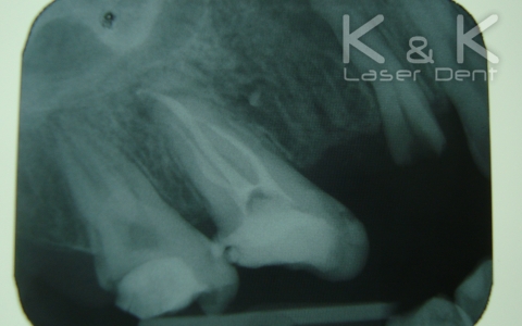 1. Диагноза : Pulpitis chronica ulcerosa на зъб 16, рентгенография след лечение.
