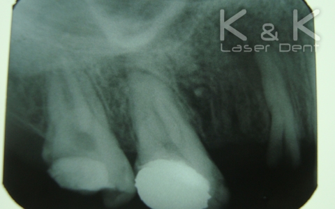 1. Диагноза : Pulpitis chronica ulcerosa на зъб 16, рентгенография преди лечение.