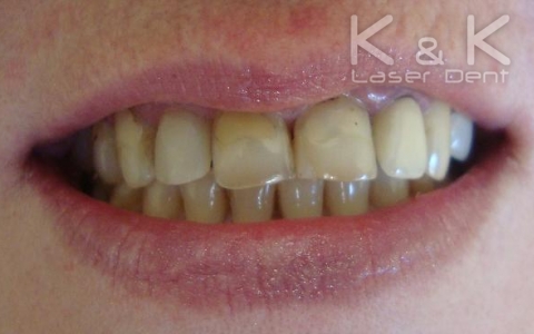 Случай 2. Състояние на пациента преди поставяне на фасетите (множество стари и оцветени композитни обтурации и вторични кариеси на фронталните зъби
 