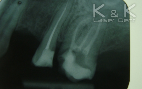 2. Диагноза : Pulpitis chronica ulcerosa на зъб 26, рентгенография след лечение.
