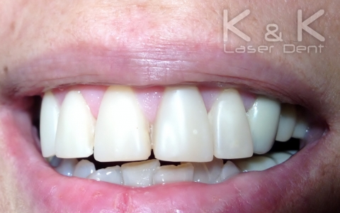 Бондинг (директно композитно възстановяване) на горните фронтални зъби