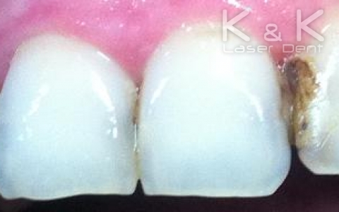 Случай 1. Вторичен кариес и оцветена стара обтурация (пломба) на зъб 22